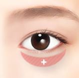  눈밑지방재배치/제거하는 방법(수술)