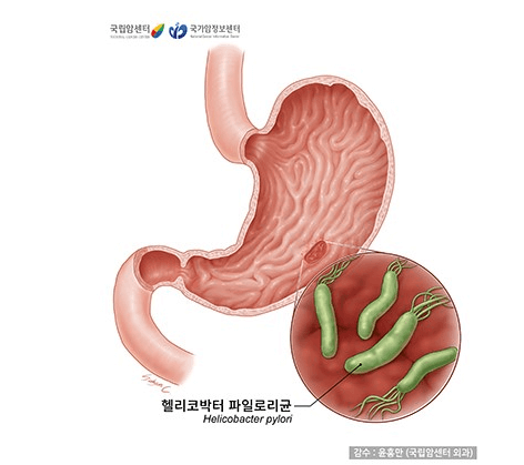 위암이해하기:증상&#44;원인&#44;진단&#44;치료방법