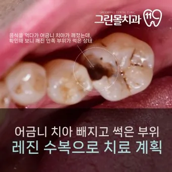 어금니 칫솔 사용법 선택방법 실사용 후기_18