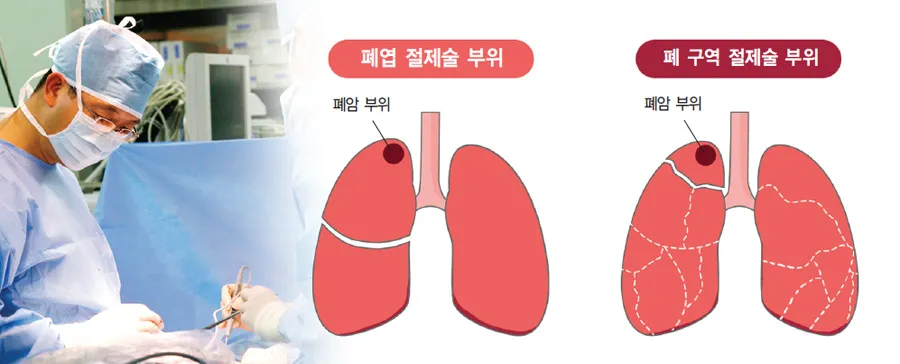 폐암 초기증상