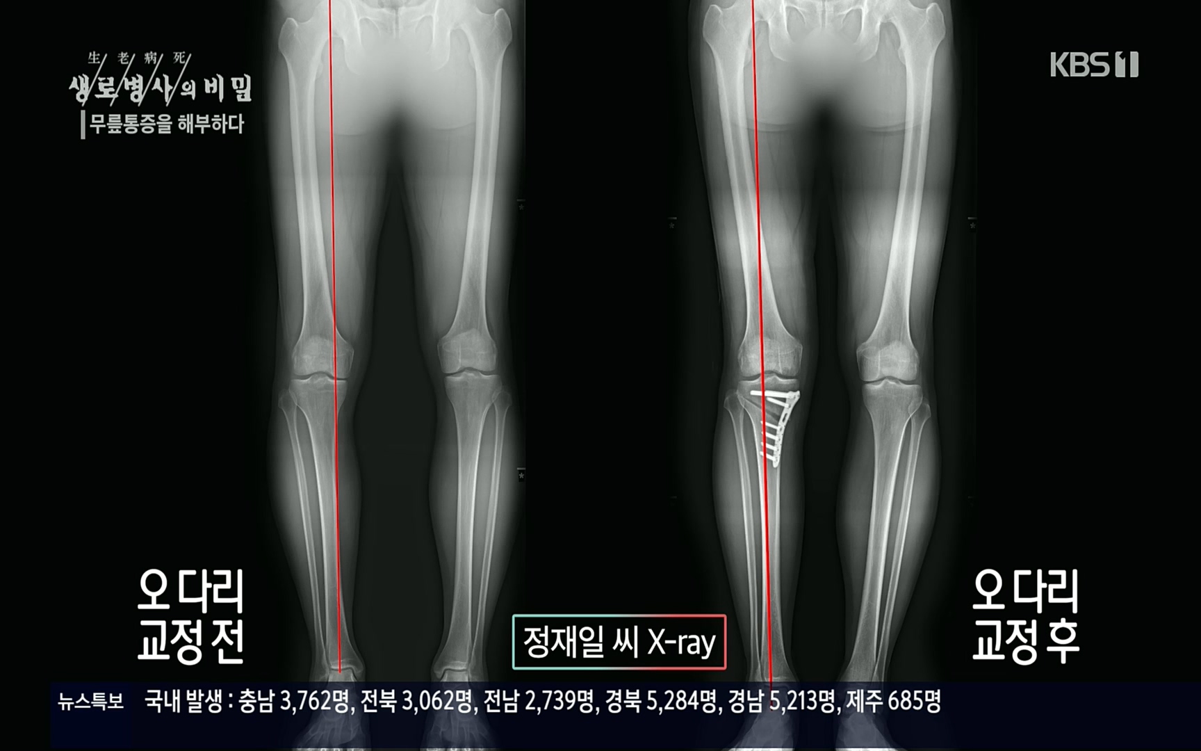 생로병사의 비밀.E834.220907p.H264-F1RST.mp4_20220908_210423.420.jpg