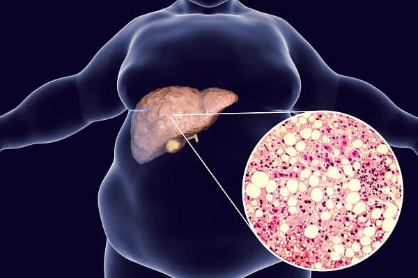  지방간 보유자, 3년 수명 짧아져 ㅣ 지방간 대책 Shorter life expectancy for people with fatty liver disease