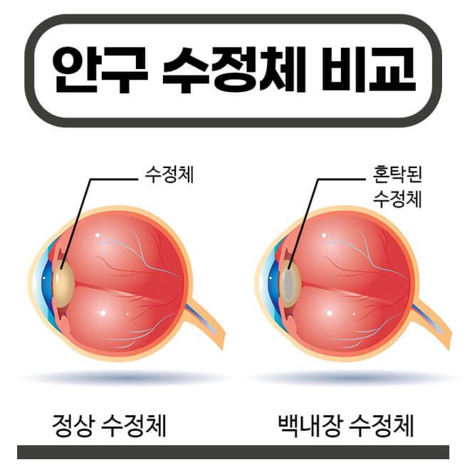 백내장 증상