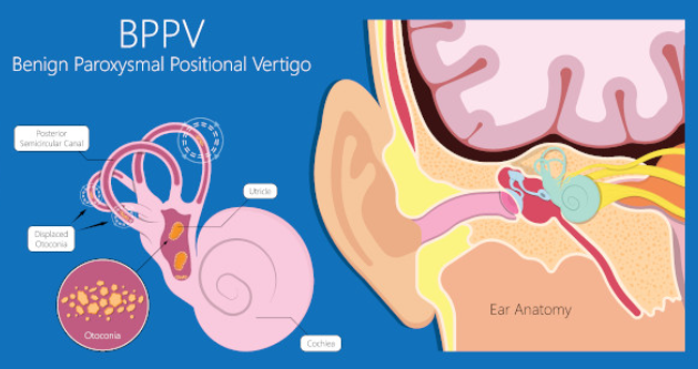 Benign-paroxysmal-vertigo