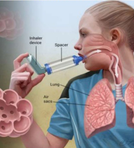  기관지 천식(Bronchial Asthma) 간호