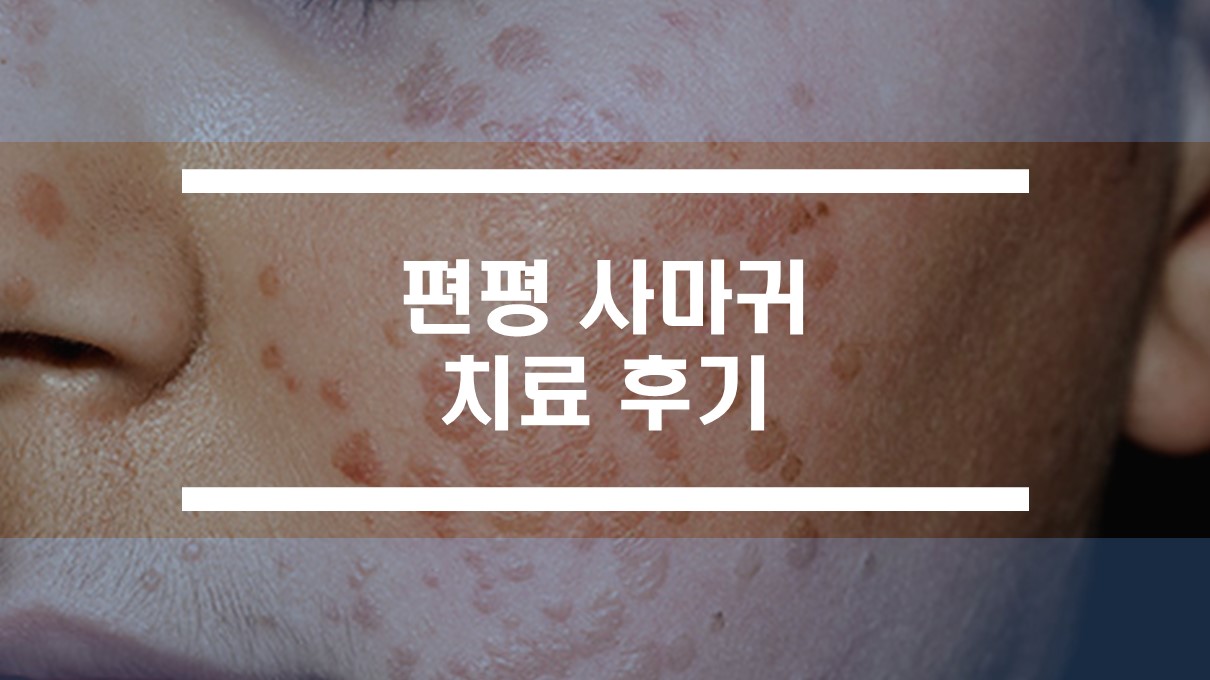  편평사마귀 레이저, 율무 치료 후기