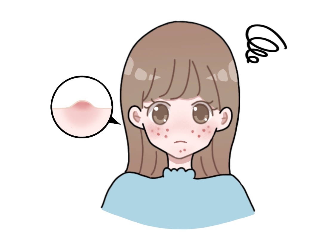  여드름에 안 좋은 음식