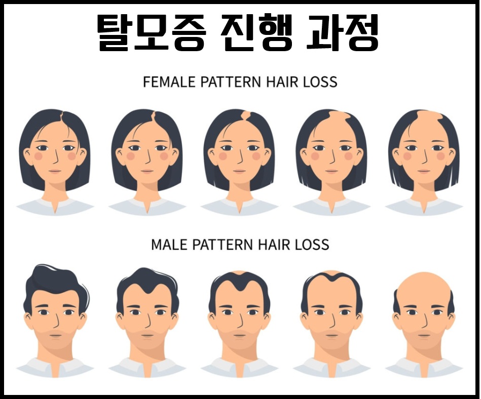 탈모증 진행 과정