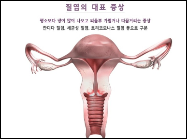  질염 치료방법- 자연치료로 가능합니다!