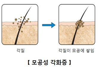 모공각화증이 생기는 과정