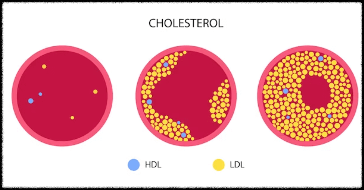 HDL-LDL