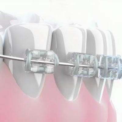 치아교정비용