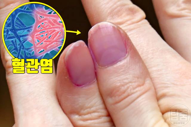 손톱 색깔 건강 손톱색깔 보라색 혈관염