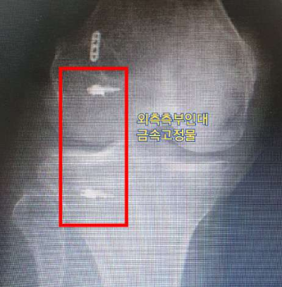 외측측부인대 금속고정물