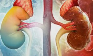 Understanding the Irreversible Functions of Kidneys and Their Management.