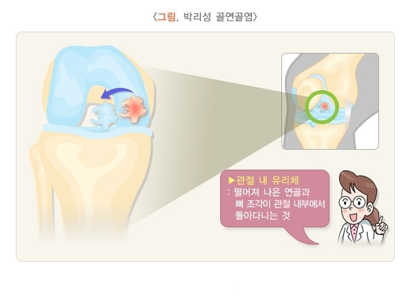  무릎 연골 손상