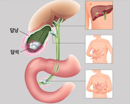 담석증-증상