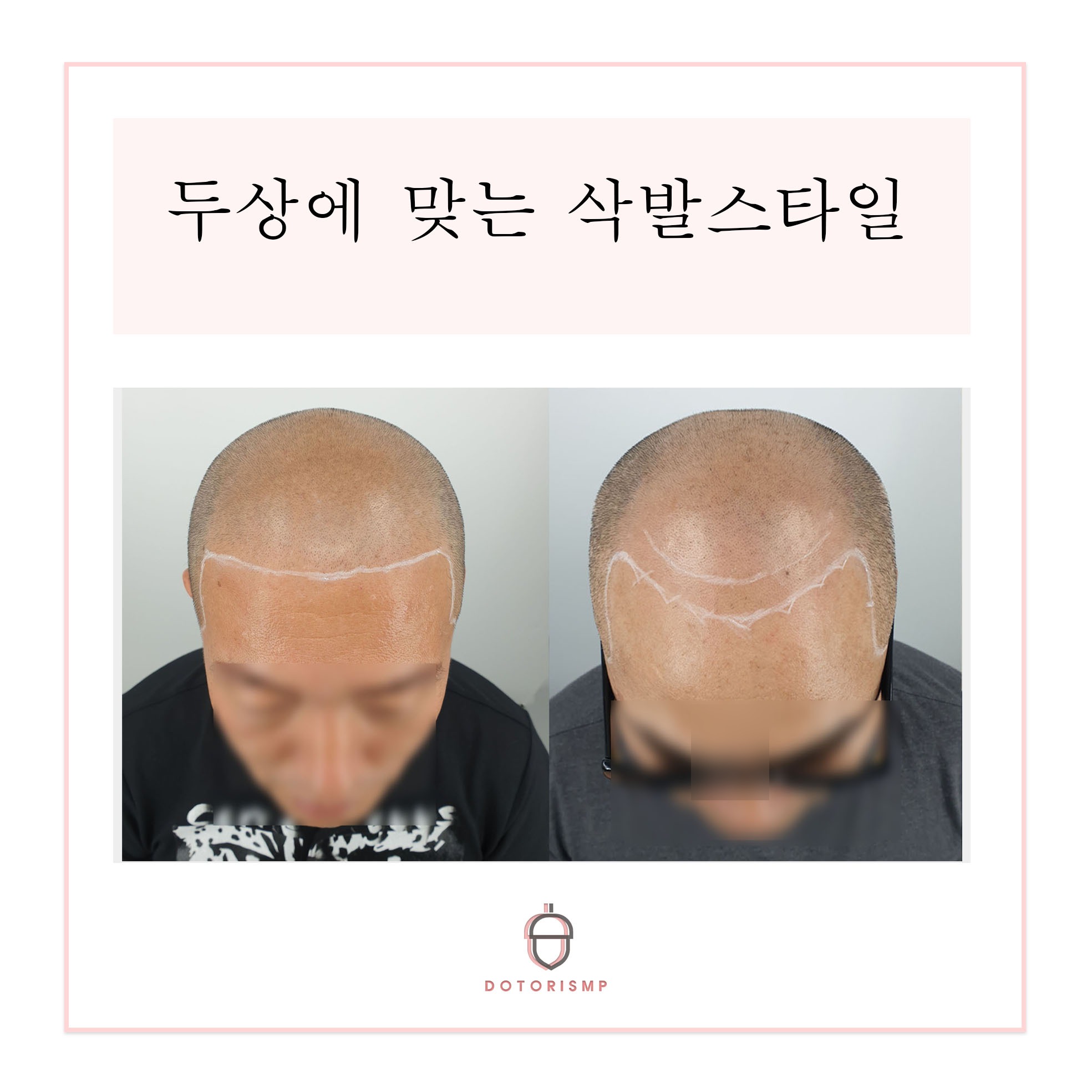  [부산두피문신] 내 두상에 맞는 삭발 스타일 확인