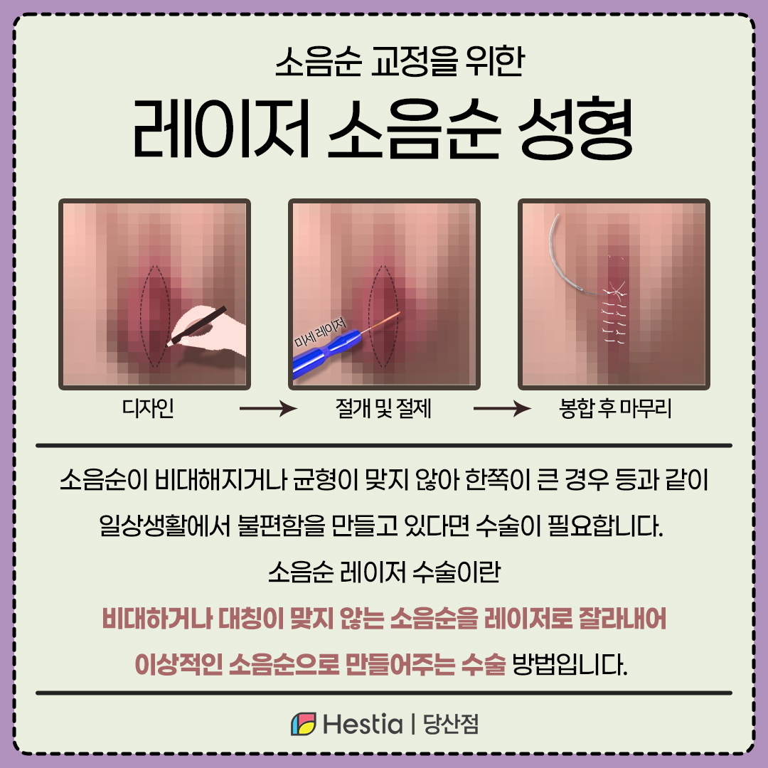 레이저 소음순 성형이란?