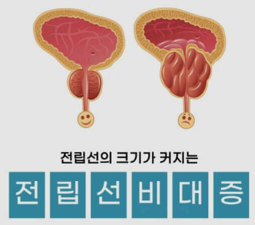 전립선의-크기가-커지는-전립선-비대증