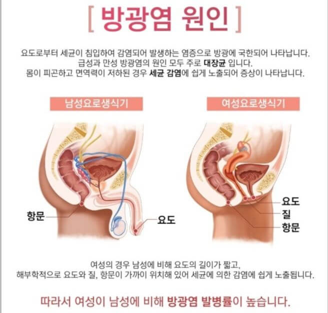 방광염 증상