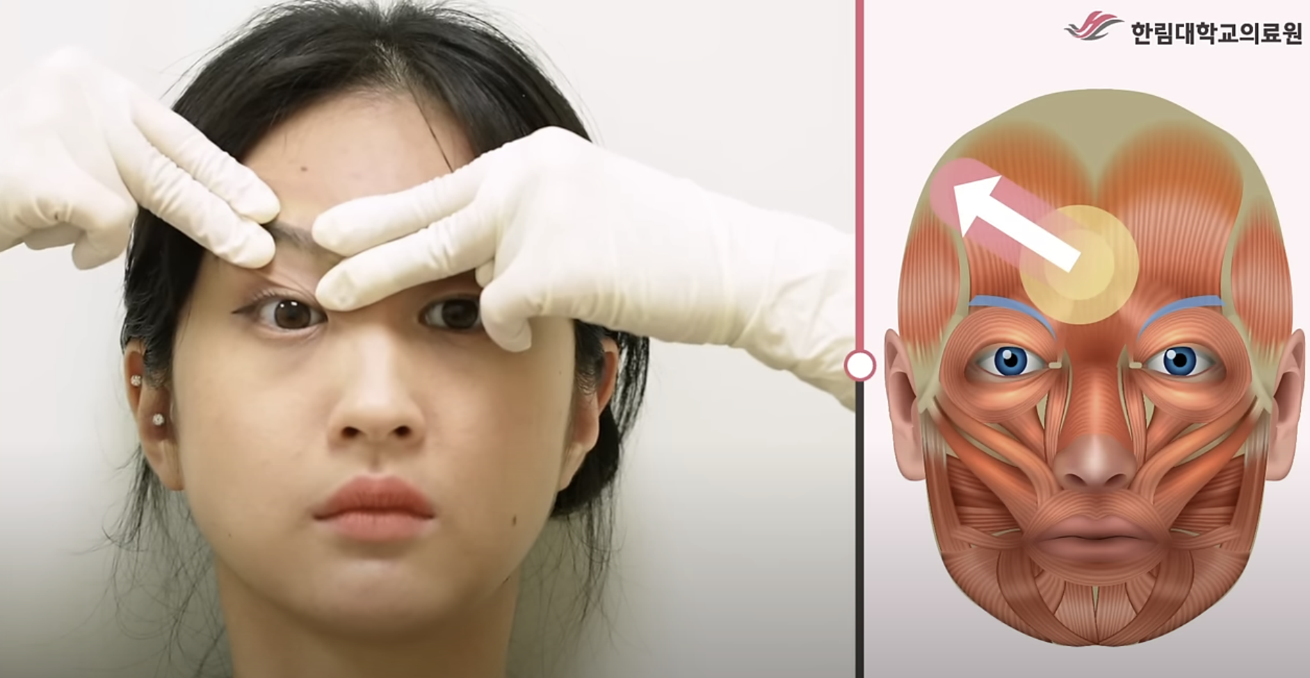눈썹주름근 스트레칭
