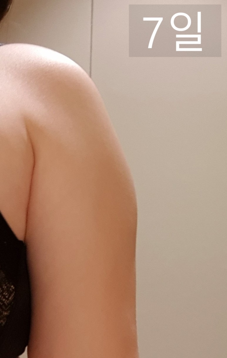 좋네요. 2회차 후기 지방분해주사 팔뚝살빼기 딱 11