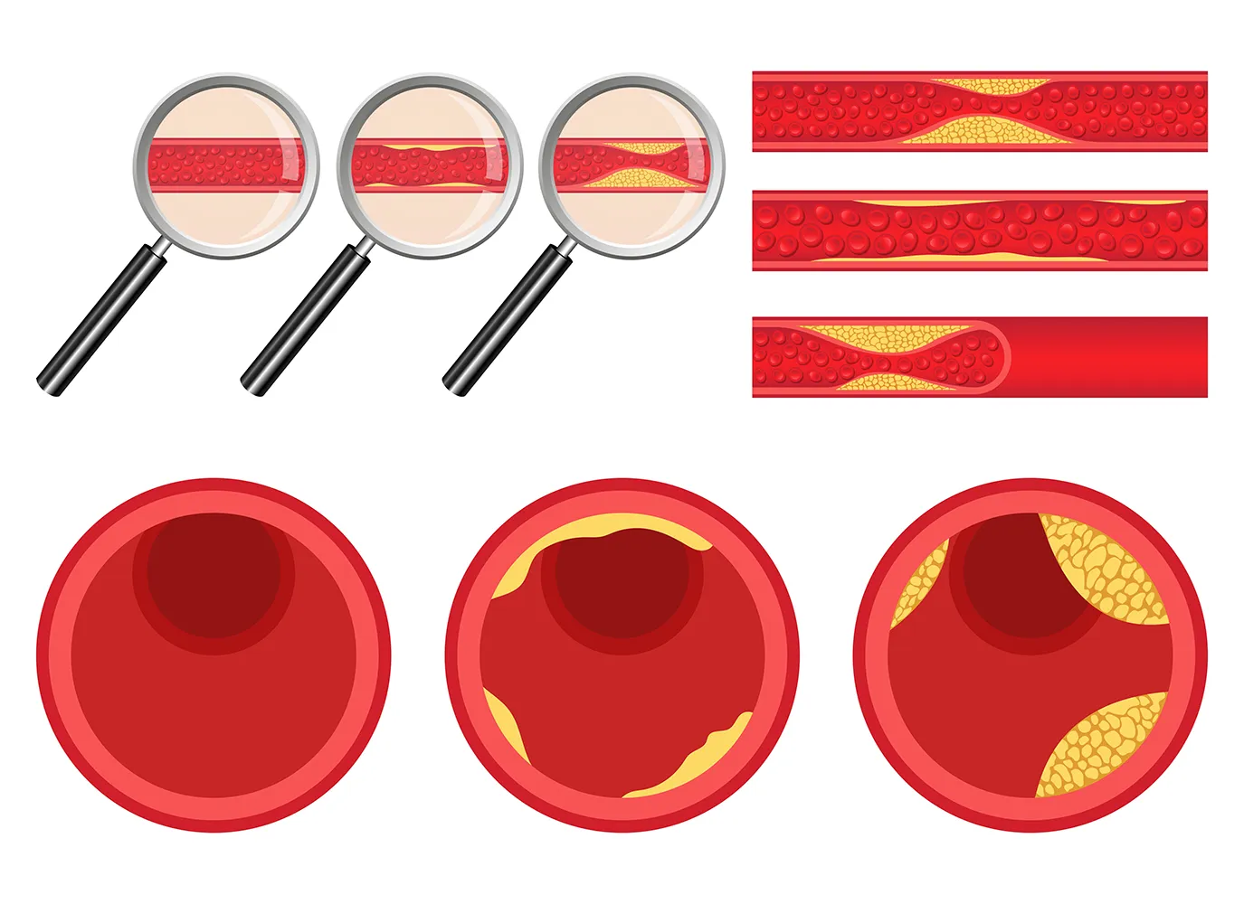 정상-혈관과-동맥경화가-발생된-혈관-비교-이미지