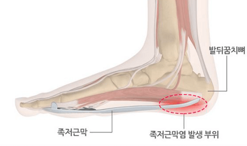 족저근막염이 발생하는 우리 발의 구조와 부위