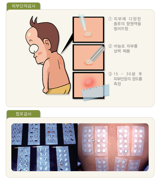 피부단자검사