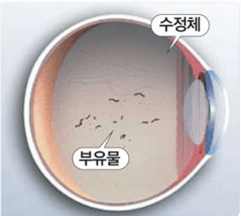 비문증 영양제 추천