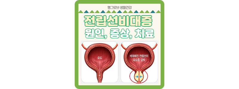 전립선비대증 썸네일