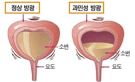 방광염 증상