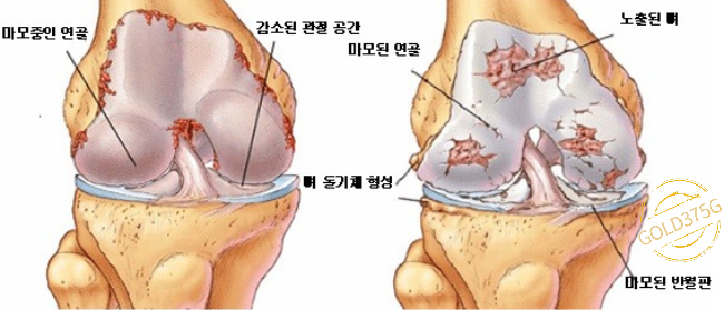 건강한-관절-VS-관절염-관절