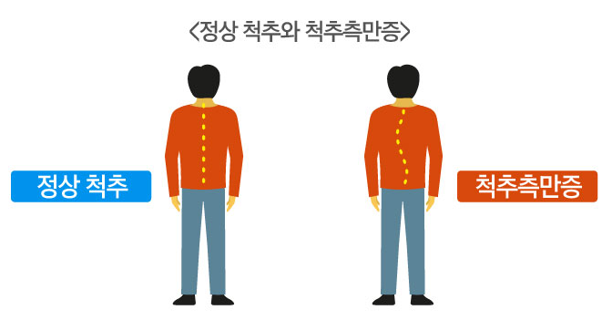 척추측만증 비교