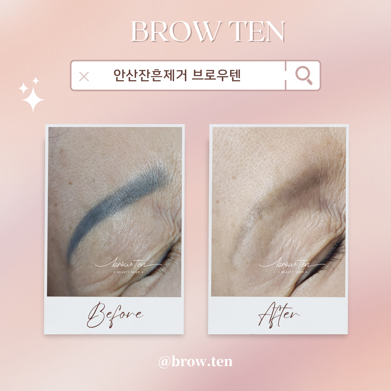  안산눈썹문신 잔흔 제거 옛날문신 지우기 정왕동눈썹문신