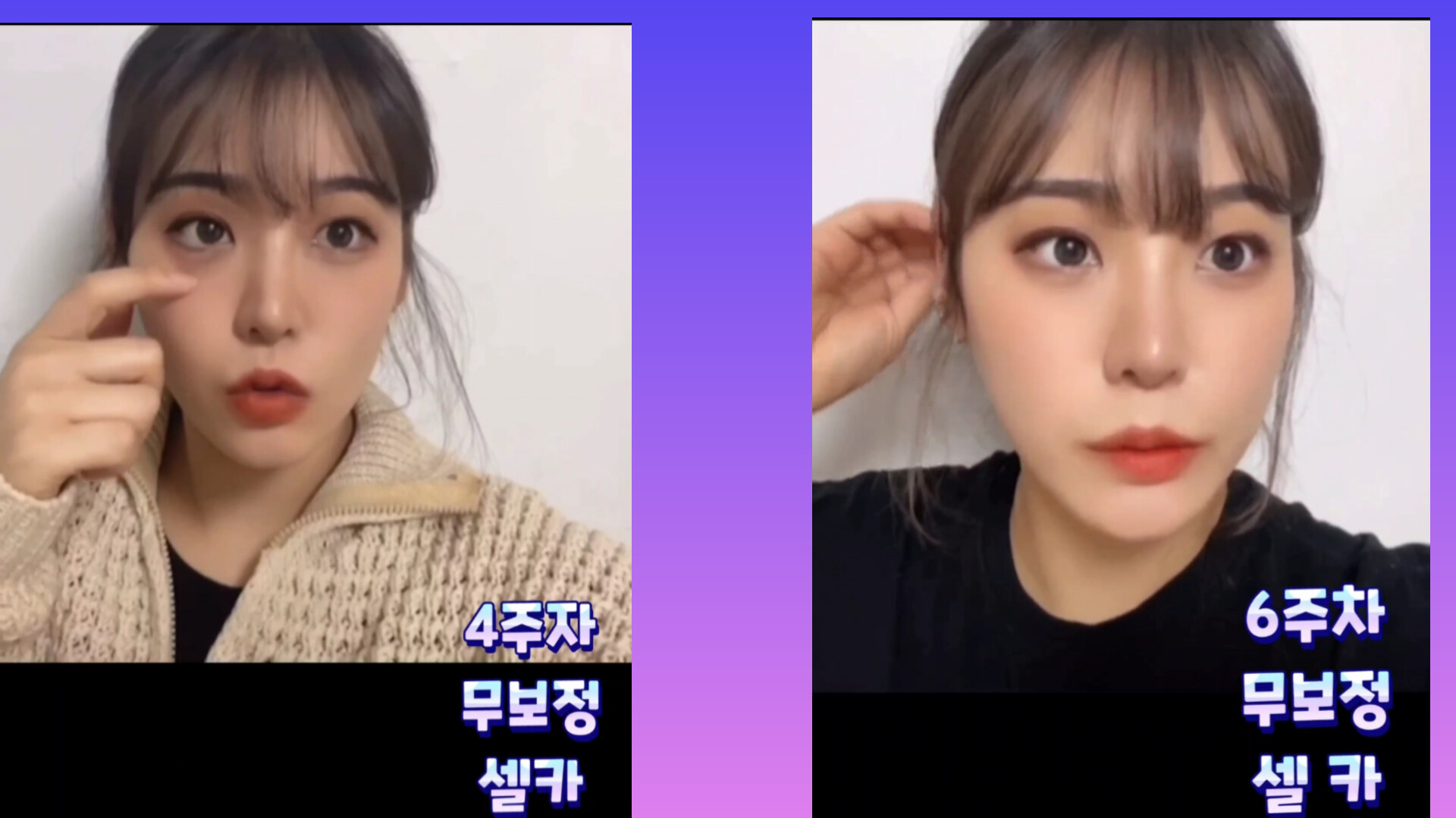  c11번째 눈재수술 4~ 6주차 무보정 셀카 ㄷㄷ