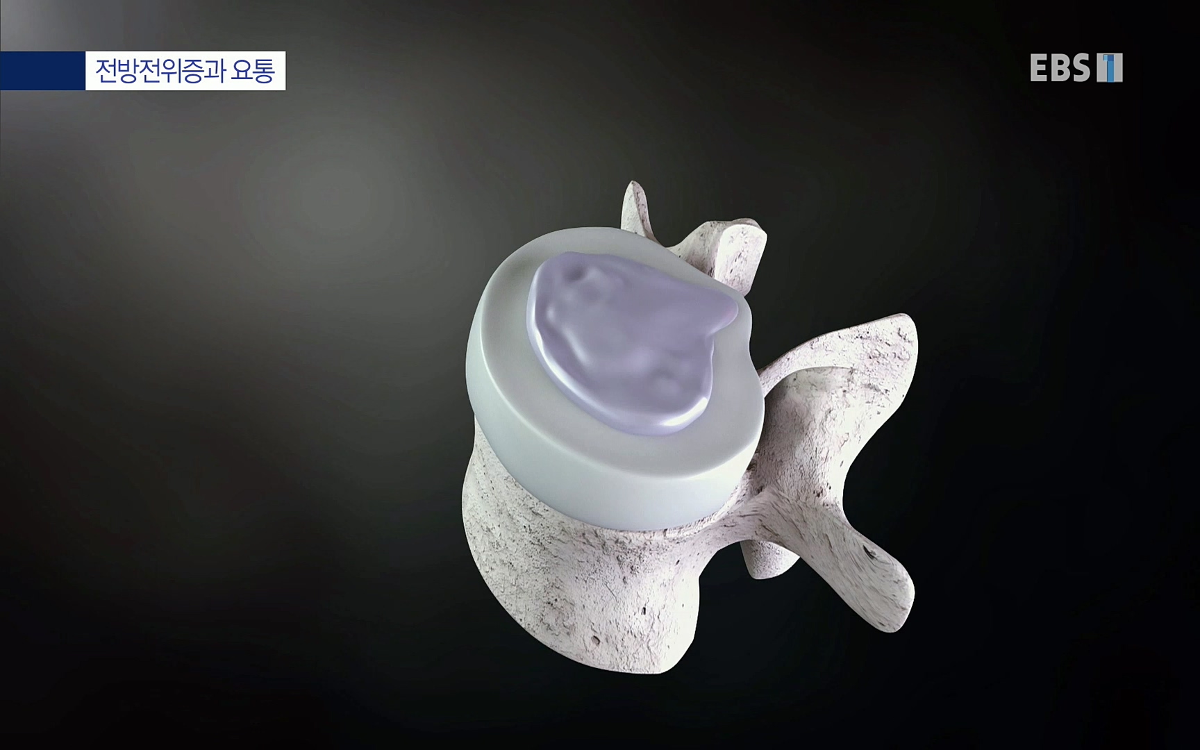 EBS 명의 헬스케어 - TV - 교육의 중심 EBS허리 통증 치료 프로젝트 1부, 수술없이 낫는다 .mp4_20220712_204231.869.jpg