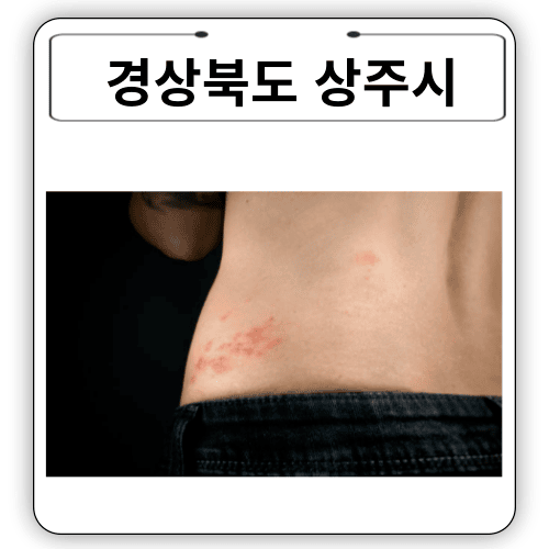 경상북도 - 상주시 대상포진