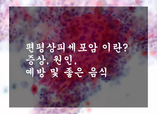  편평상피세포암 이란? 증상, 원인, 예방 및 좋은 음식