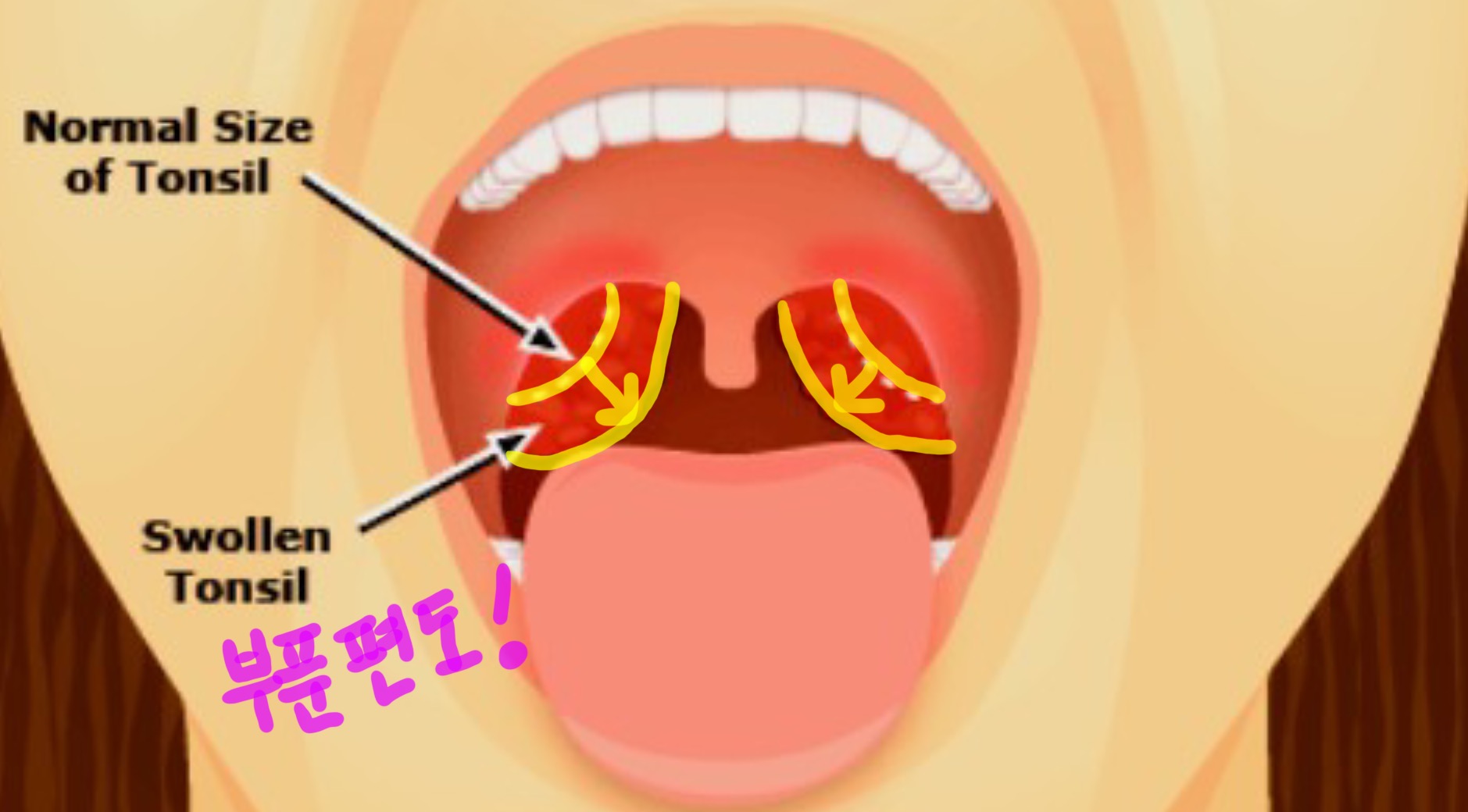  코로나 편도염 , 꼭 알아야하는 정보