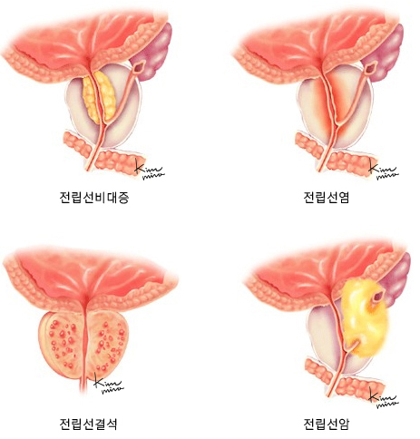 전립선 질환