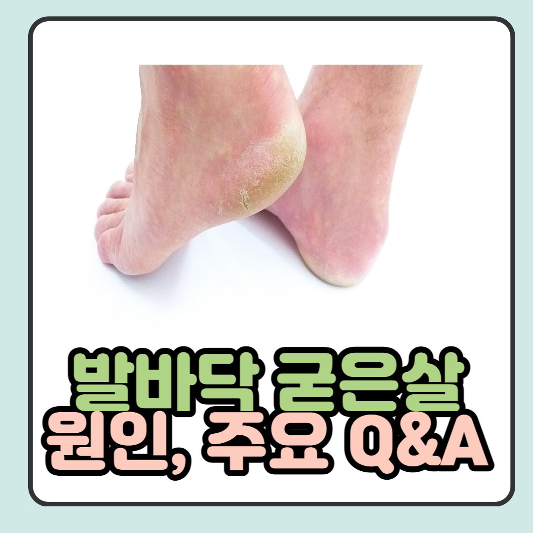  발바닥 굳은살 원인 5가지 및 주요 Q&A 총 정리