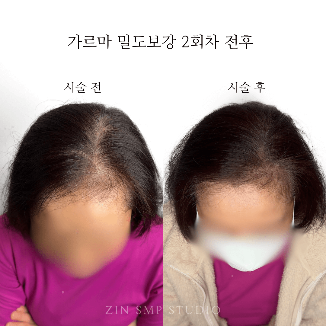 홍대두피문신