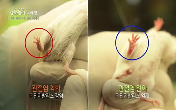 [792회] 생로병사의 비밀 - KBS[세균의 습격, 당신의 잇몸을 지켜라!] 감기보다 병원을 더 자주 찾게 만드는 질병이 있다. 바로 치주질환이다. 2020년 외래 다빈도 질병 1위를 차지한 치은염 및 치주질환 환자는 1,637_20220505_140819.146.jpg