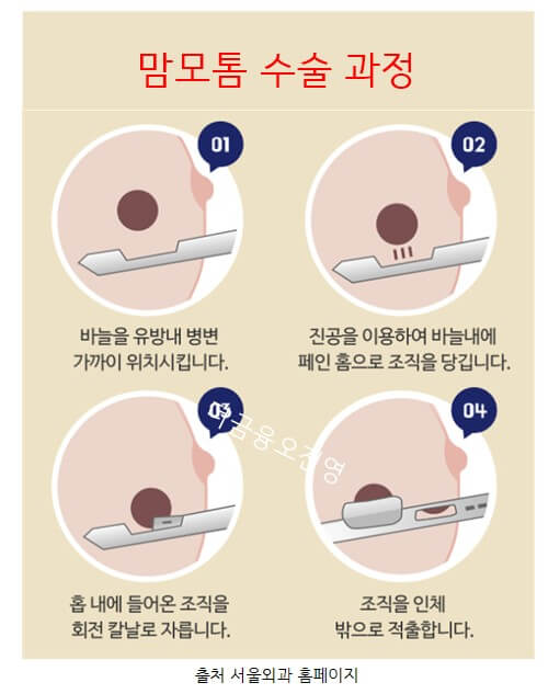 맘모톰시술비용과 주의사항