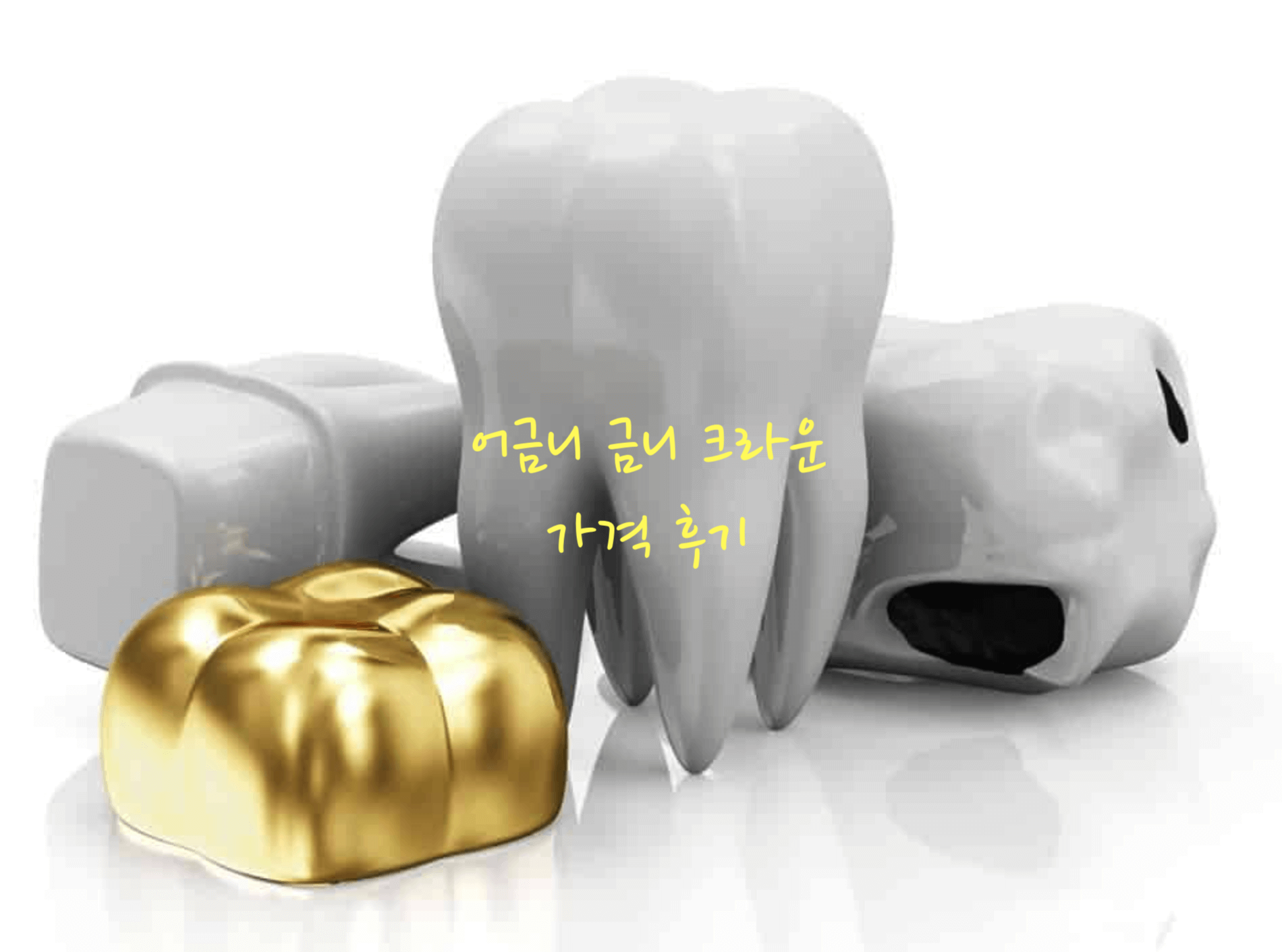  어금니 금니 크라운 가격 후기