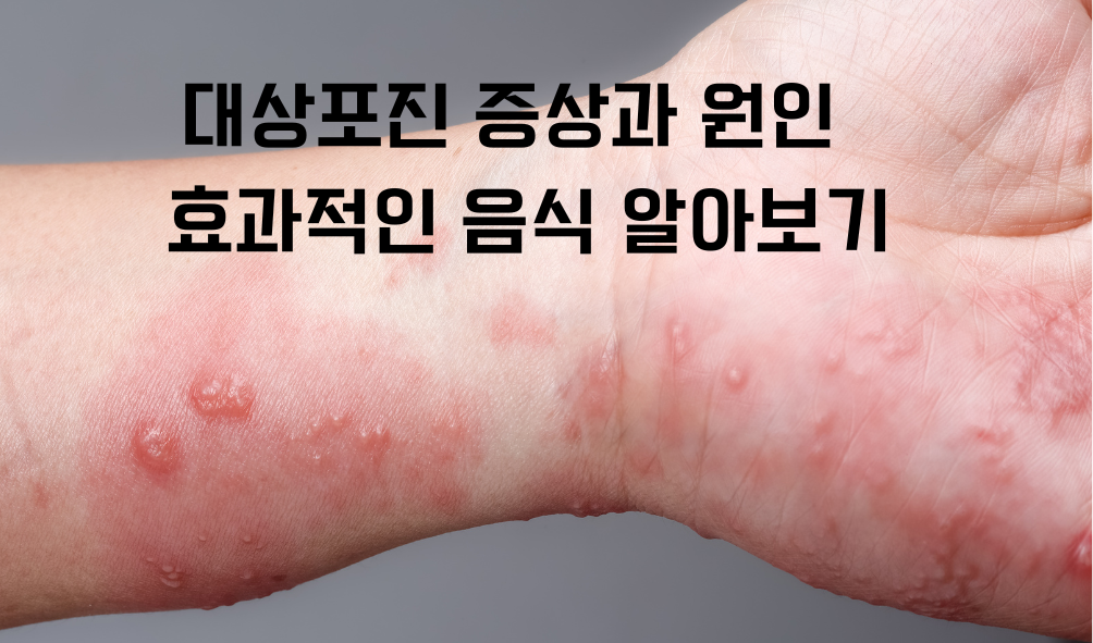  대상 포진에 좋은 영양제와 증상 및 원인알아보기