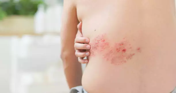 대상포진 초기증상 치료방법