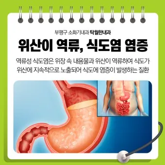 식후 속쓰림 원인 해결법 총정리_11